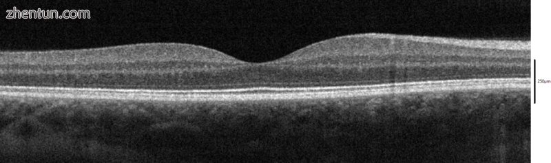 Spectral-Domain OCT macula cross-section scan..png