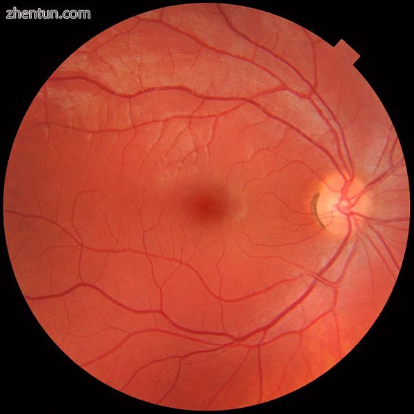 Fundus photograph showing the blood vessels in a normal human retina..jpg