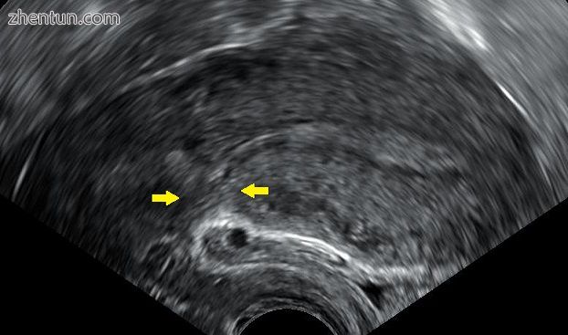 Transvaginal ultrasonography of a uterus years after a caesarean section, showin.jpg
