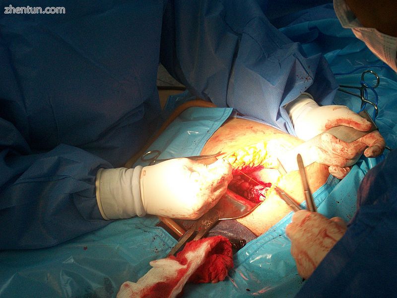 Suturing of the uterus after extraction.JPG