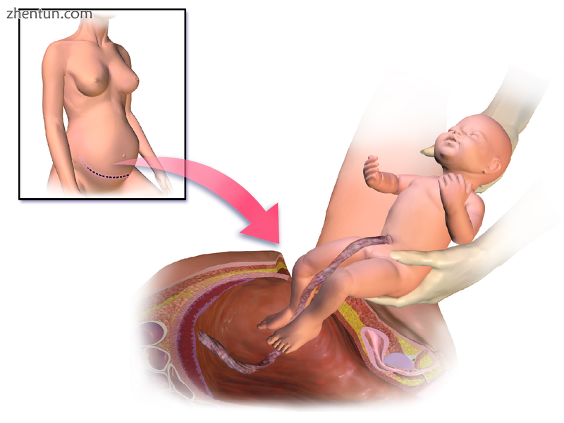 Illustration depicting caesarean section.png