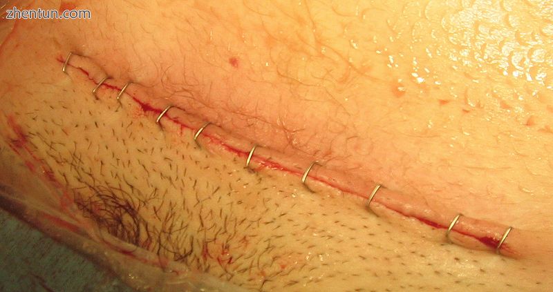 Closed incision for low transverse abdominal incision after stapling has been co.jpg