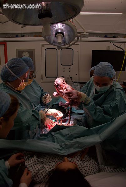 A team performing a caesarean section[1].jpg