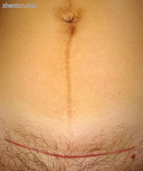 A 7-week old caesarean section scar and linea nigra visible on a 31-year-old mothe.JPG
