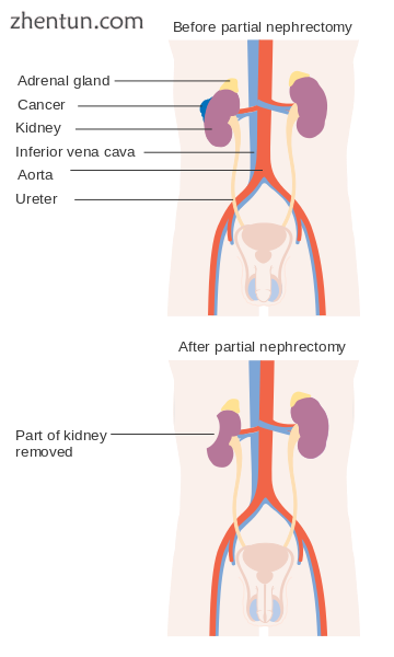 Before and after a partial nephrectomy.png