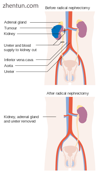 Before and after a radical nephrectomy.png