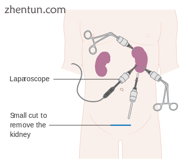 Laparoscopic nephrectomy.png