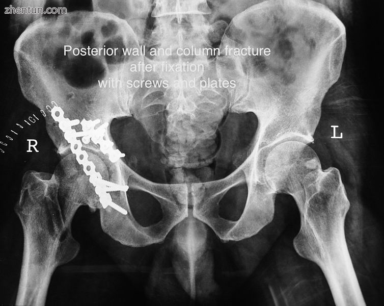 Posterior column and wall fixed using screws and plates.jpg