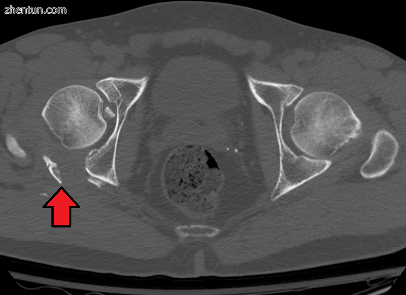 Fracture of the acetabulum.png