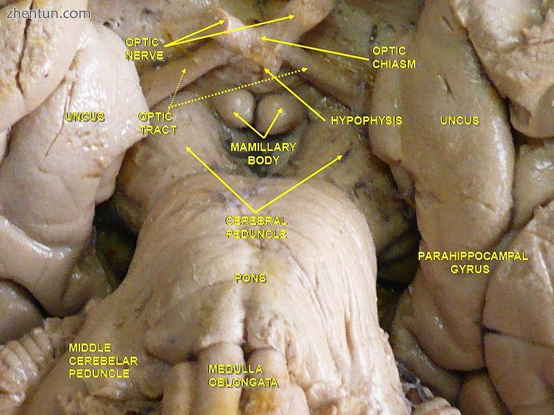 Cerebrum.Inferior view.Deep dissection..JPG