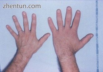 A normal sized hand (left) and the enlarged hand of someone with acromegaly (right).JPEG