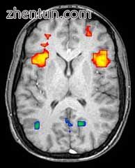 Axial MRI slice at the level of the basal ganglia, showing fMRI BOLD signal chan.jpg