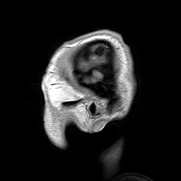Para-sagittal MRI of the head in a patient with benign familial macrocephaly..gif