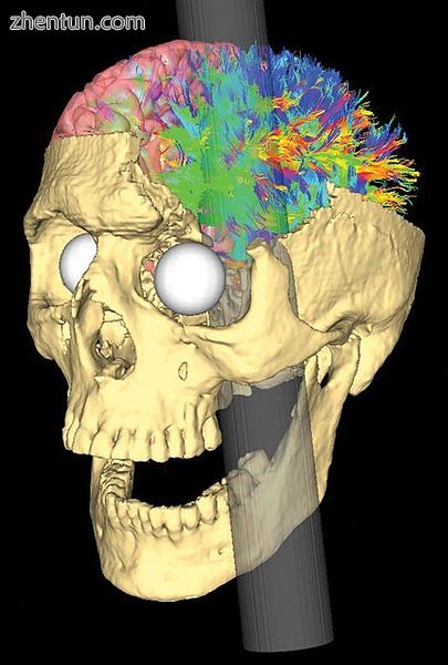 Simulated Connectivity Damage of Phineas Gage 4 vanHorn PathwaysDamaged left.jpg