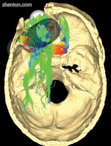 False-color representtations of cerebral fiber pathways affected in Phineas Gage.jpg