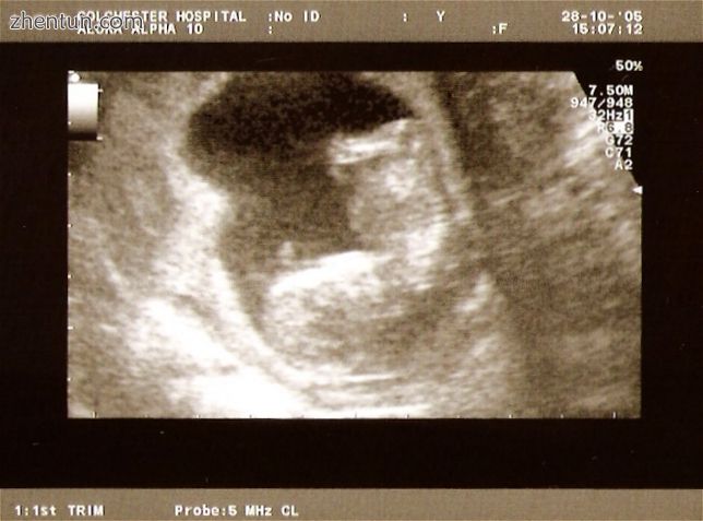 A dating scan at 12 weeks..jpg