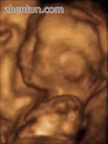 Fetus at 20 weeks.jpg