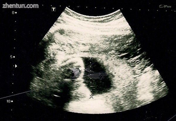 The result of an Ultrasonography.jpg