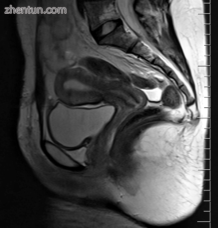 Sagittal MRI showing the location of the vagina, cervix, and uterus.png