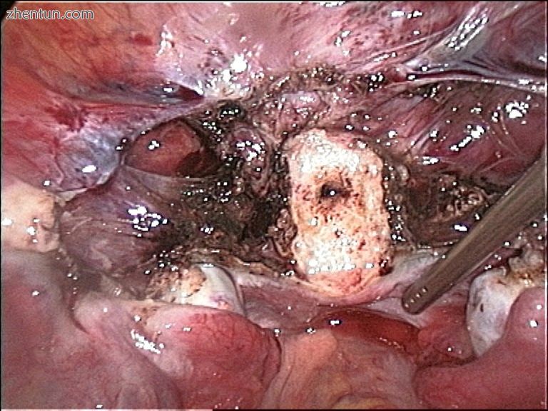 Cervical stump (white) after removal of the uterine corpus at laparoscopic supra.jpg