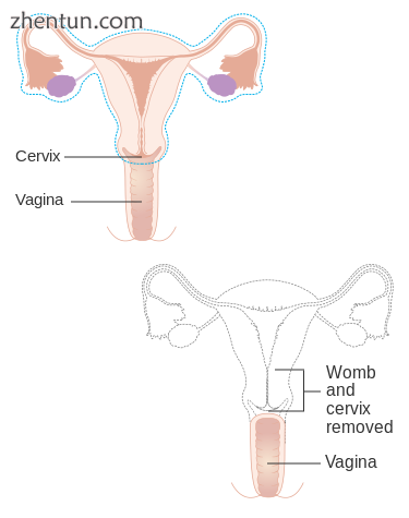 Diagram showing what is removed with a radical hysterectomy.png