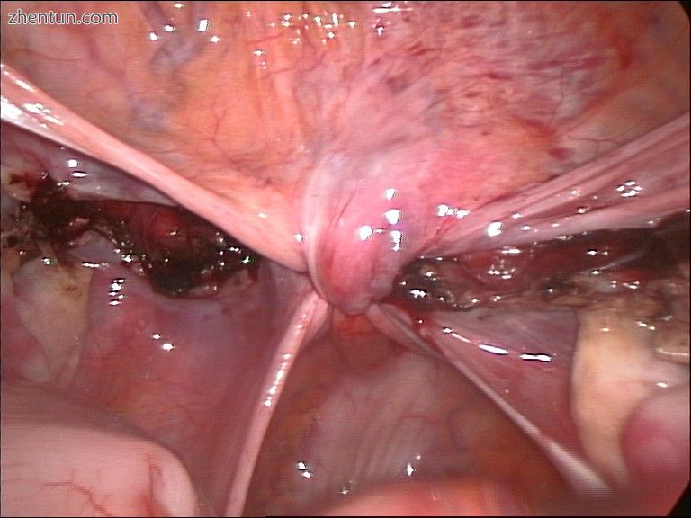 End of an laparoscopical hysterectomy.jpg
