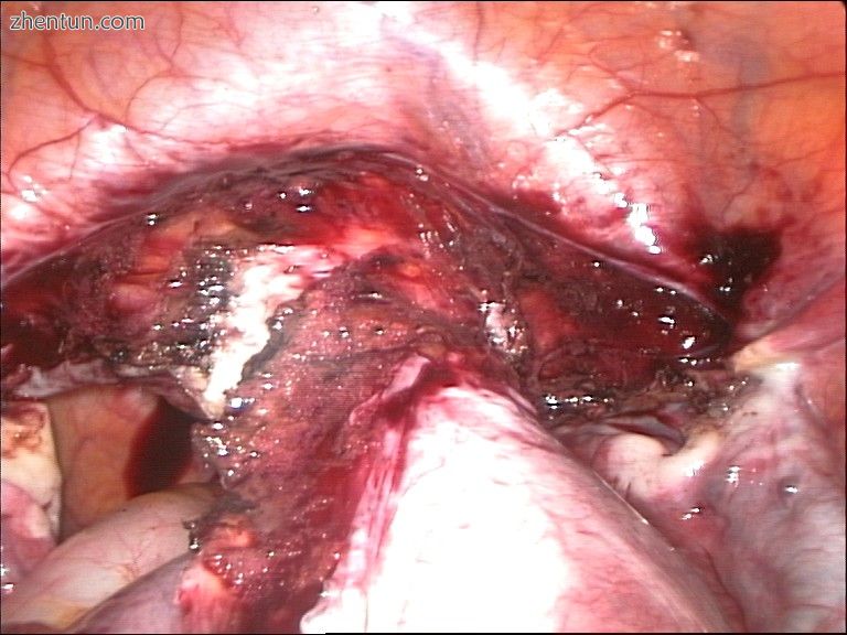 Laparoscopical hysterectomy.jpg