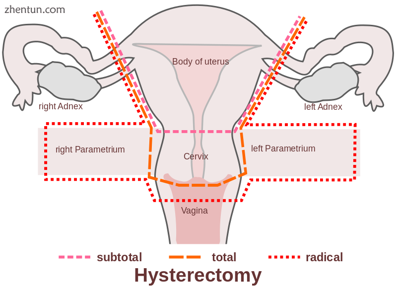 Schematic drawing of types of hysterectomy.png