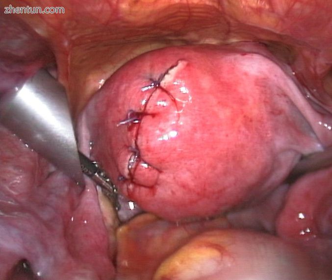 Sutured uterus wound after myomectomy.jpg