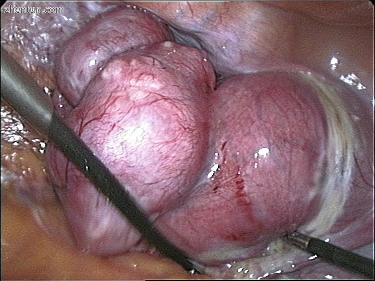 Transvaginal extraction of the uterus in total laparoscopical hysterectomy.jpg