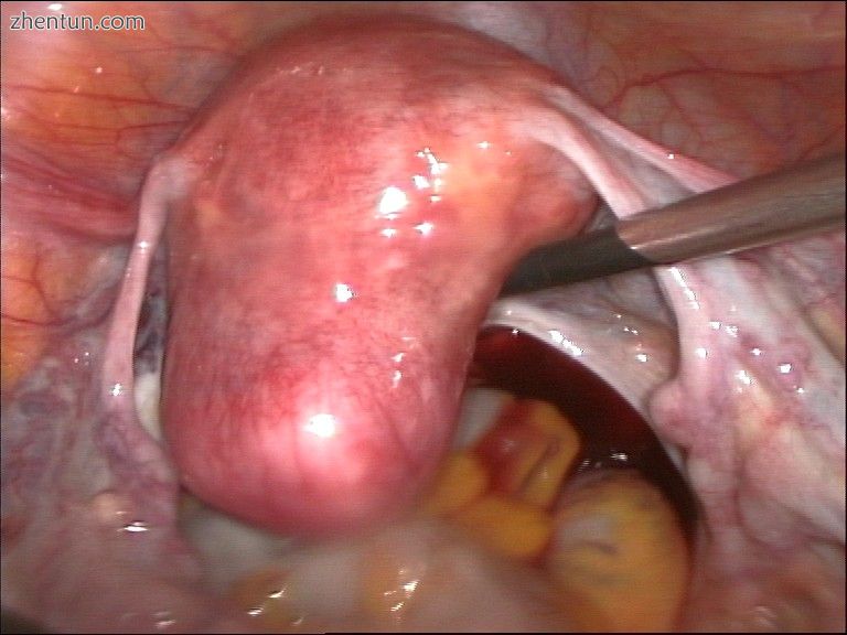 Uterus prior to hysterectomy.jpg