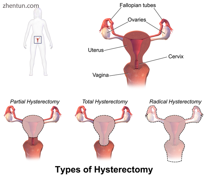 Hysterectomy.png