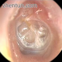 Retracted ear drum.jpg