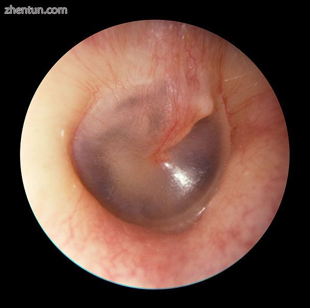 The eardrum as viewed from the outside using an otoscope. The outer ear ends at .jpg