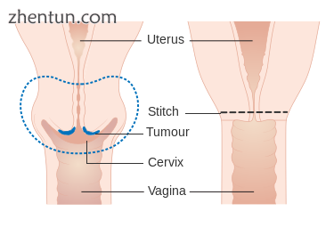 Diagram showing the parts removed with a trachelectomy.png