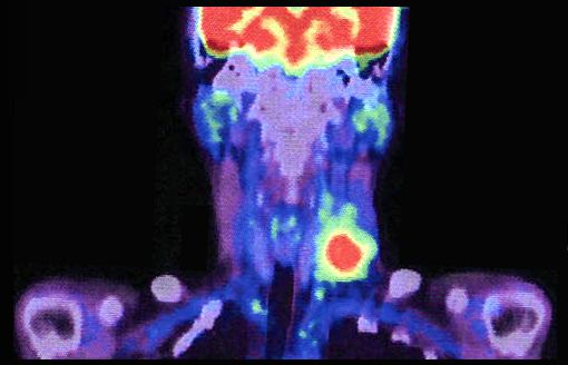 Spread of cancer beyond the capsule of a lymph node (ENE )..jpg