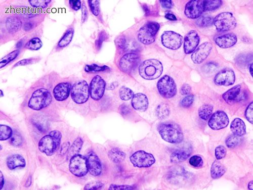 Micrograph of a papillary thyroid carcinoma demonstrating diagnostic features (n.jpg