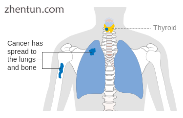 Stage M1 thyroid cancer.png