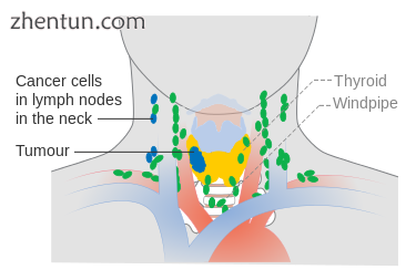 Stage N1b thyroid cancer.png