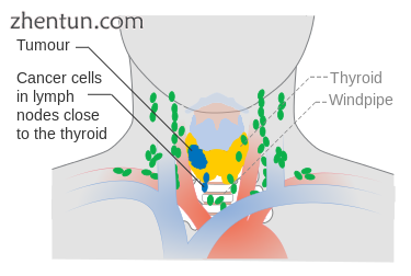 Stage N1a thyroid cancer.png