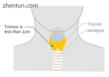 Stage T1a thyroid cancer.png