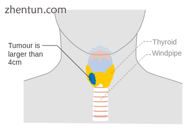 Stage T3 thyroid cancer.png