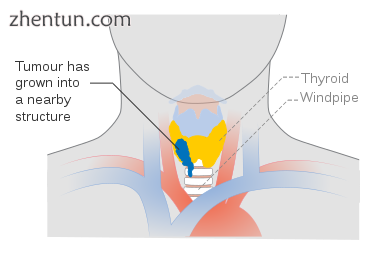 Stage T4a thyroid cancer.png