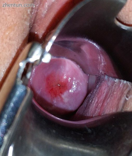 A nulliparous woman&#039;s ectocervix showing Cervical ectropion, visible as the.jpg