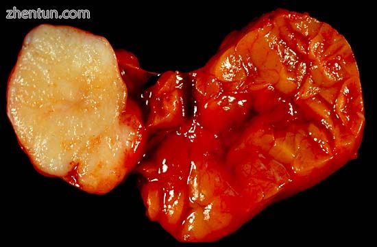 Benign tumour of the submandibular gland.jpg