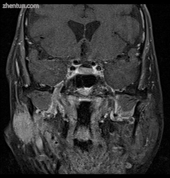Coronal MRI showing right parotid adenoid cystic carcinoma..jpg