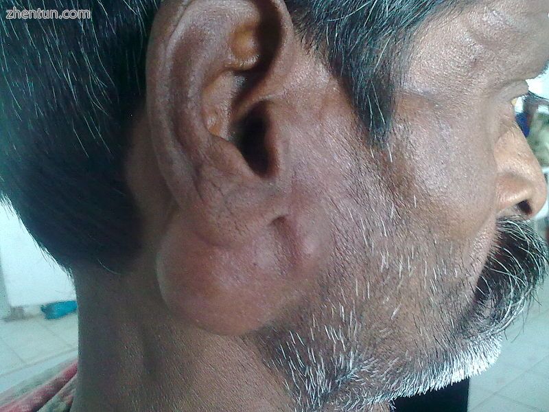 Parotid gland tumour.jpg