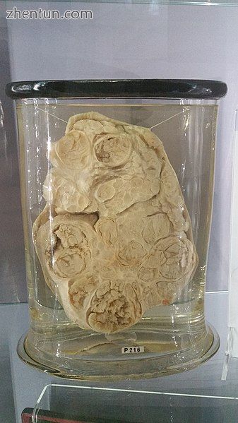 Specimen from a parotid gland tumour. It was removed by John Hunter from a.jpg