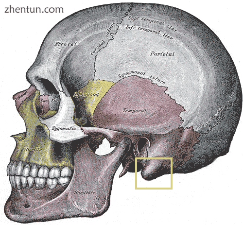 Auricular prominence in the occipital area, behind the pinna, a protruding masto.png