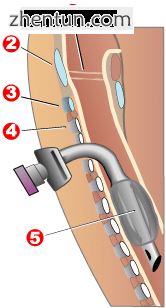 Completed tracheotomy.png